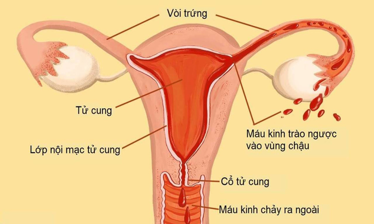 Hình minh họa nội mạc tử cung