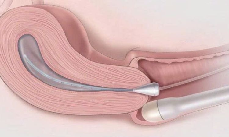 Siêu âm bơm nước buồng tử cung (SIS) là một trong những kỹ thuật siêu âm chuyên sâu giúp đánh giá sự thông suốt của vòi trứng