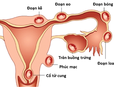 Hình ảnh minh họa vị trí thường gặp của thai ngoài tử cung 